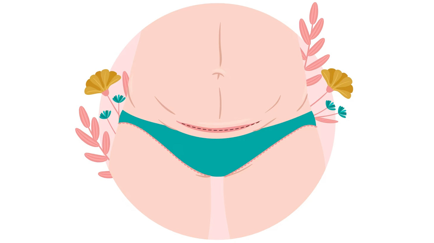 Combatting C-section Scars: Discover the Benefits of Silicone Tape